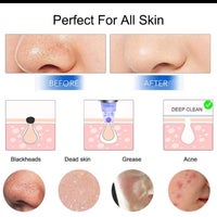 Electronic Blackhead Remover - Image 2